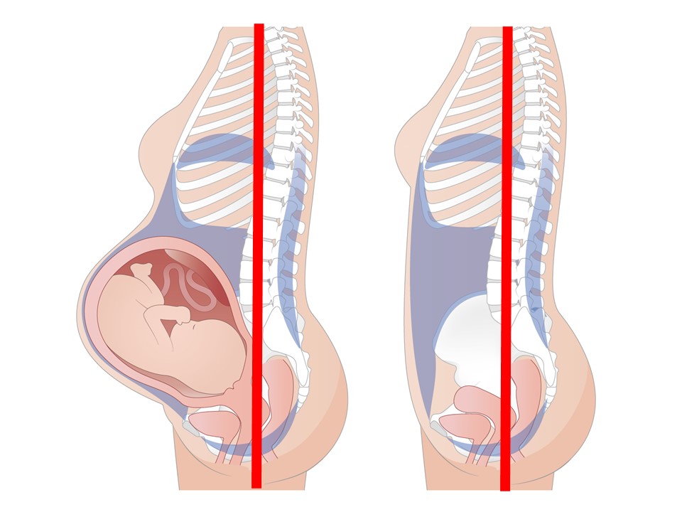 妊娠中の腰痛の原因と予防のポイント
